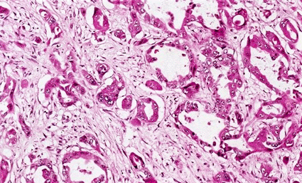 Image: Light micrograph of tissue from a pancreas in a case of pancreatic cancer (Photo courtesy of Biophoto Associates / SPL).